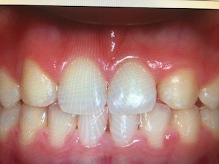 missing lateral incisors after