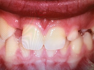 missing lateral incisors before